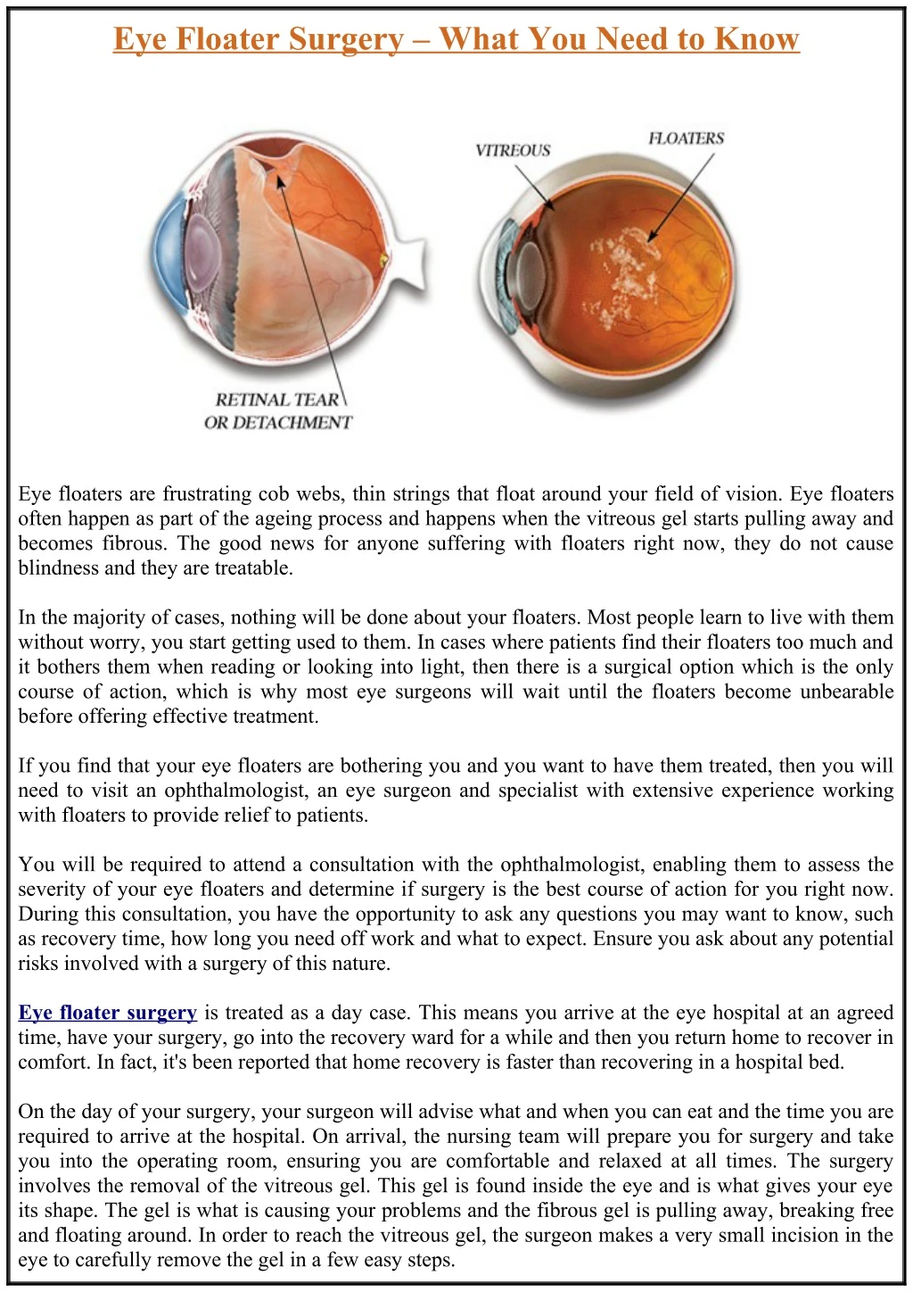 eye floater surgery what you need to know