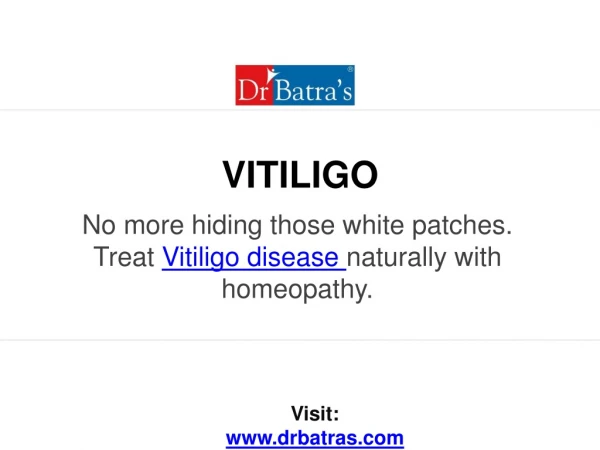 Vitiligo