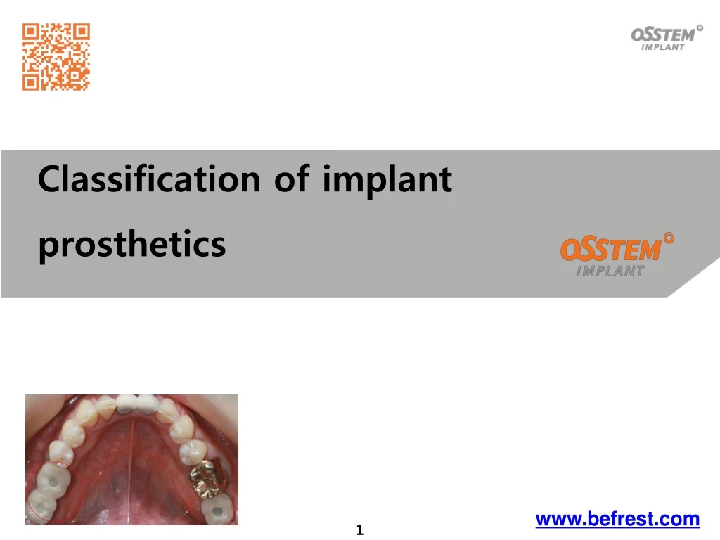 classification of implant prosthetics