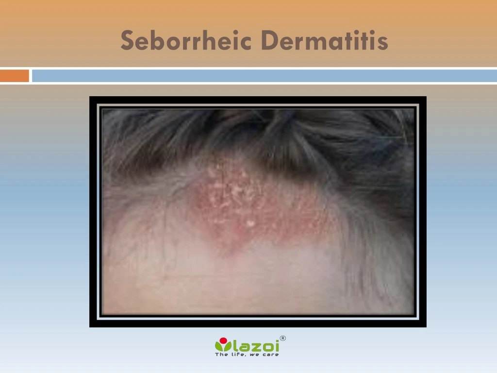 seborrheic dermatitis