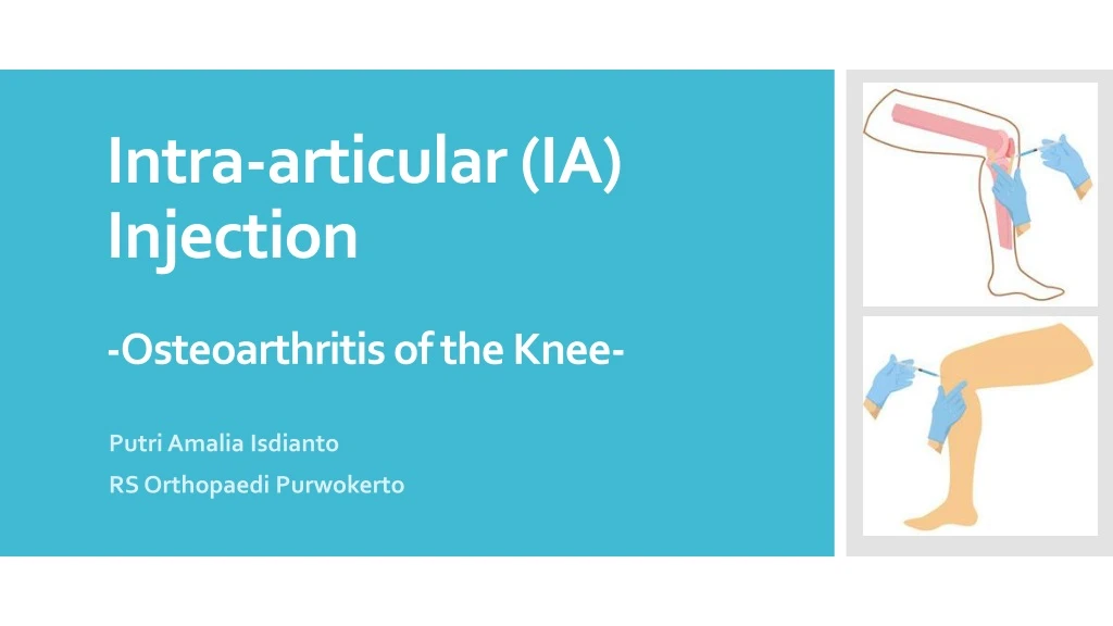 intra articular ia injection osteoarthritis of the knee