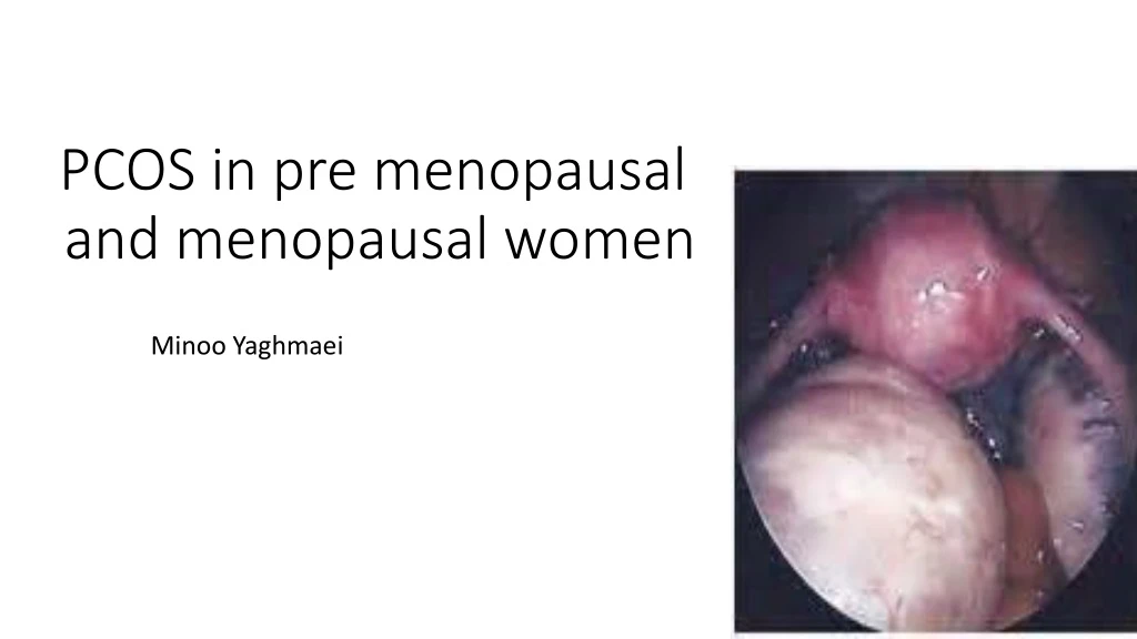 pcos in pre menopausal and menopausal women