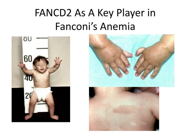 FANCD2 As A Key Player in Fanconi’s Anemia