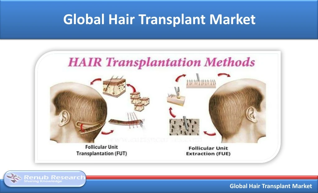 Ppt Hair Transplant Market Global Industry Trends Forecast 2019 2025 Powerpoint