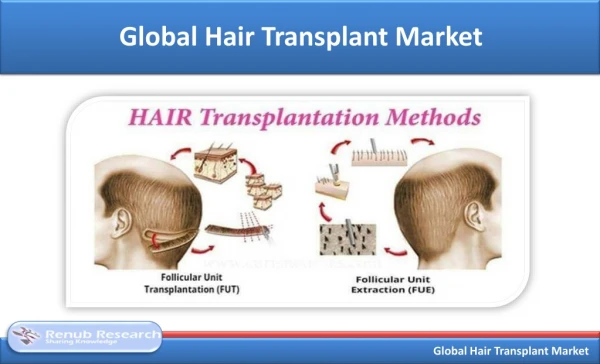 Global Hair Transplant Market is US$ 30 Billion by 2025 - Renub Research