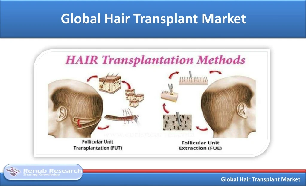 global hair transplant market