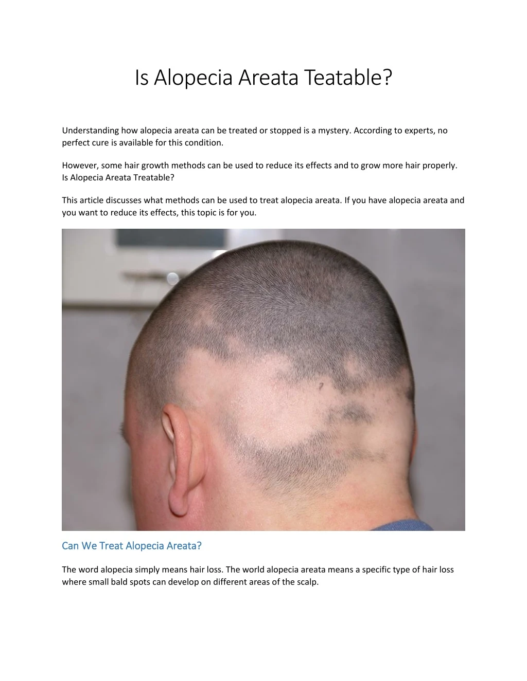 is alopecia areata teatable