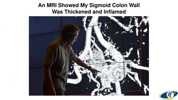 An MRI Showed My Sigmoid Colon Wall Was Thickened and Inflamed