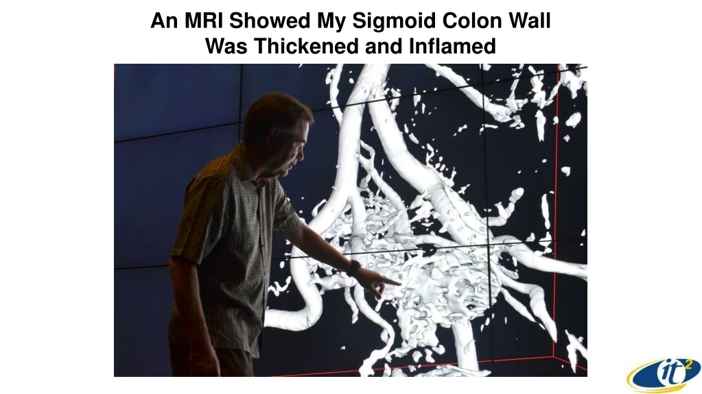 an mri showed my sigmoid colon wall was thickened and inflamed