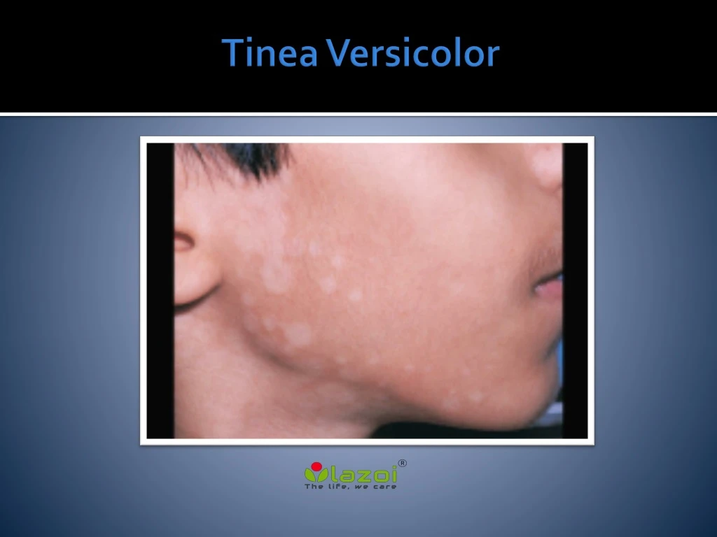 tinea versicolor