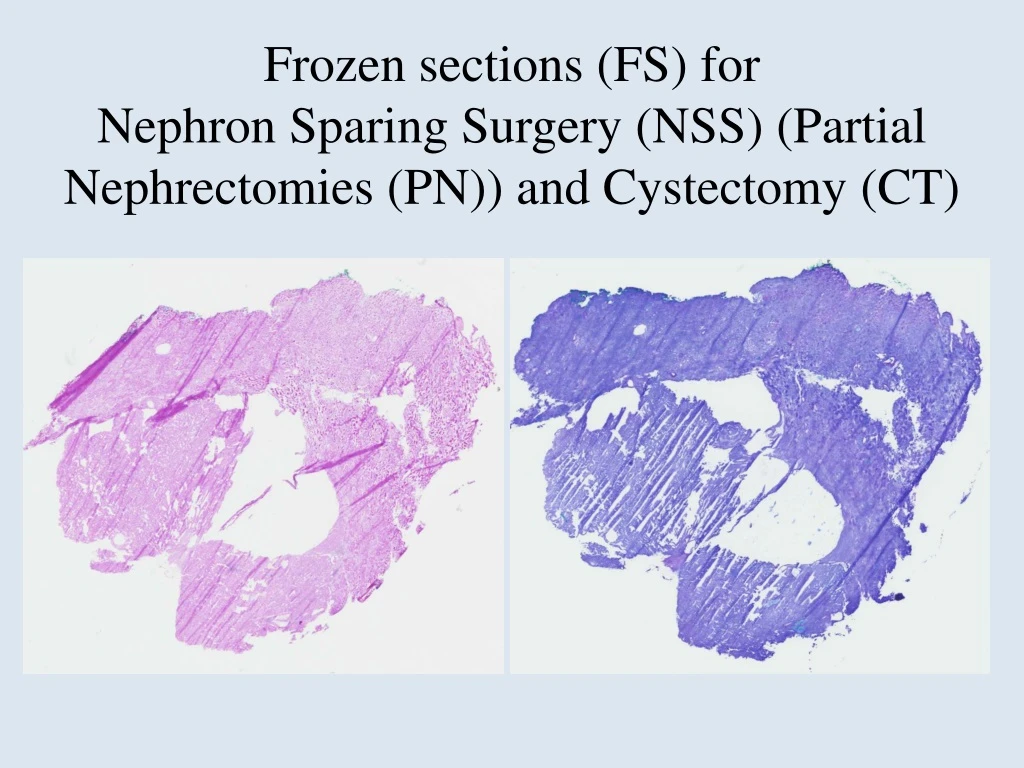 frozen sections fs for nephron sparing surgery nss partial nephrectomies pn and cystectomy ct