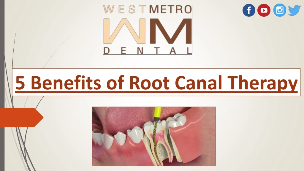 5 benefits of root canal therapy