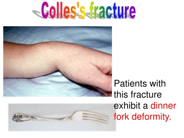 Colles's fracture