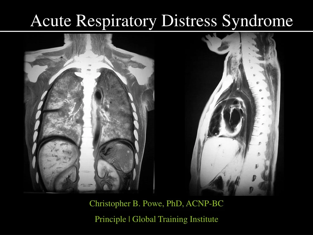 acute respiratory distress syndrome