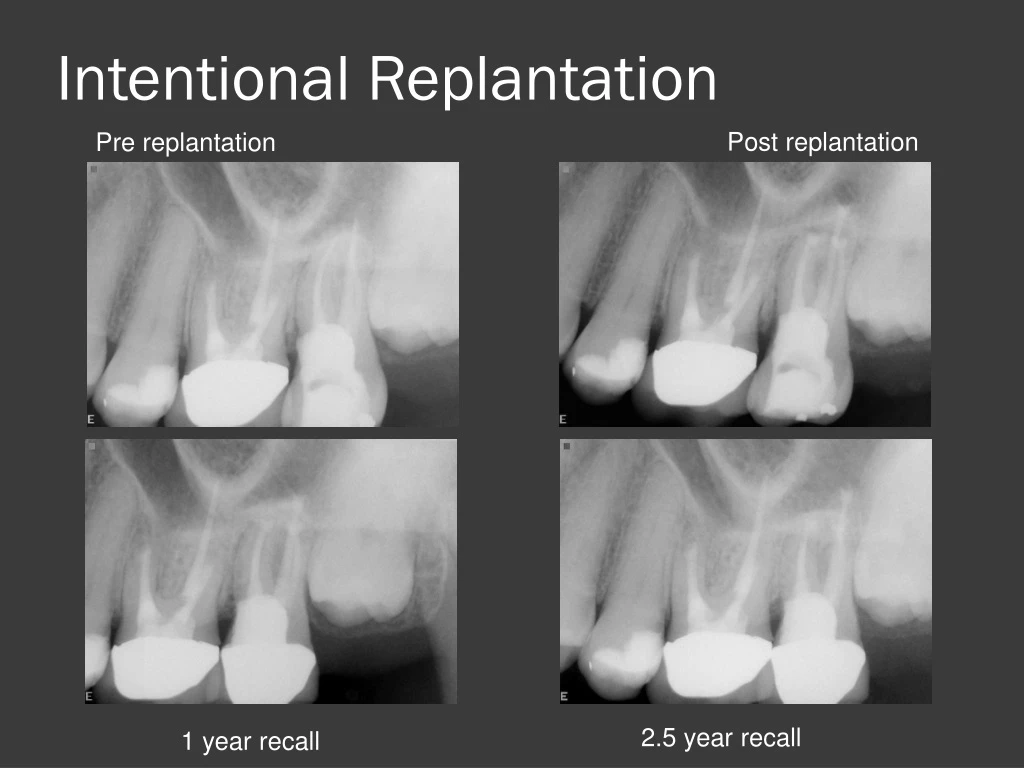 intentional replantation