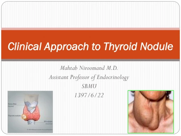 Clinical Approach to Thyroid Nodule