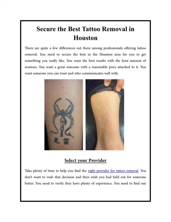 Secure the Best Tattoo Removal in Houston