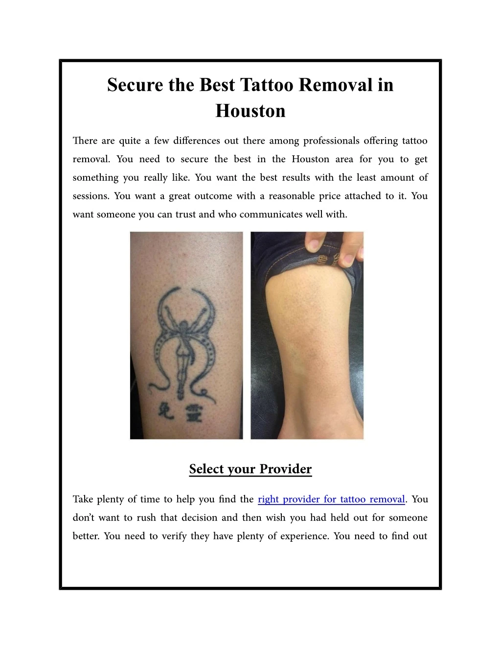 secure the best tattoo removal in houston