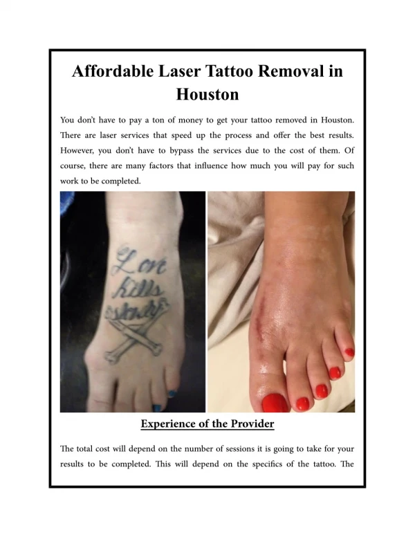 Affordable Laser Tattoo Removal in Houston