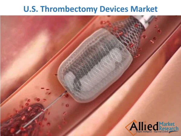 U.S. Thrombectomy Devices Market Expected to Reach $750.4 Million by 2025