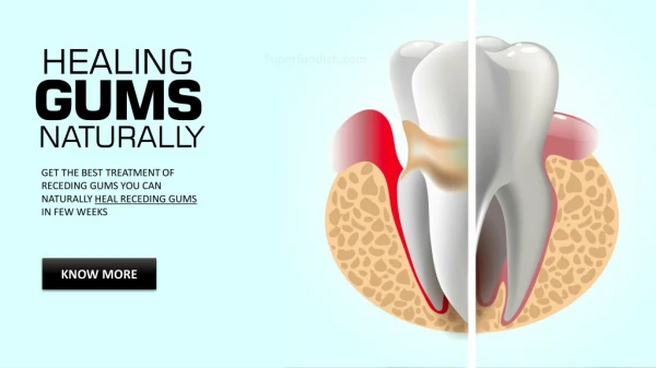 Heal Receding Gums Naturally