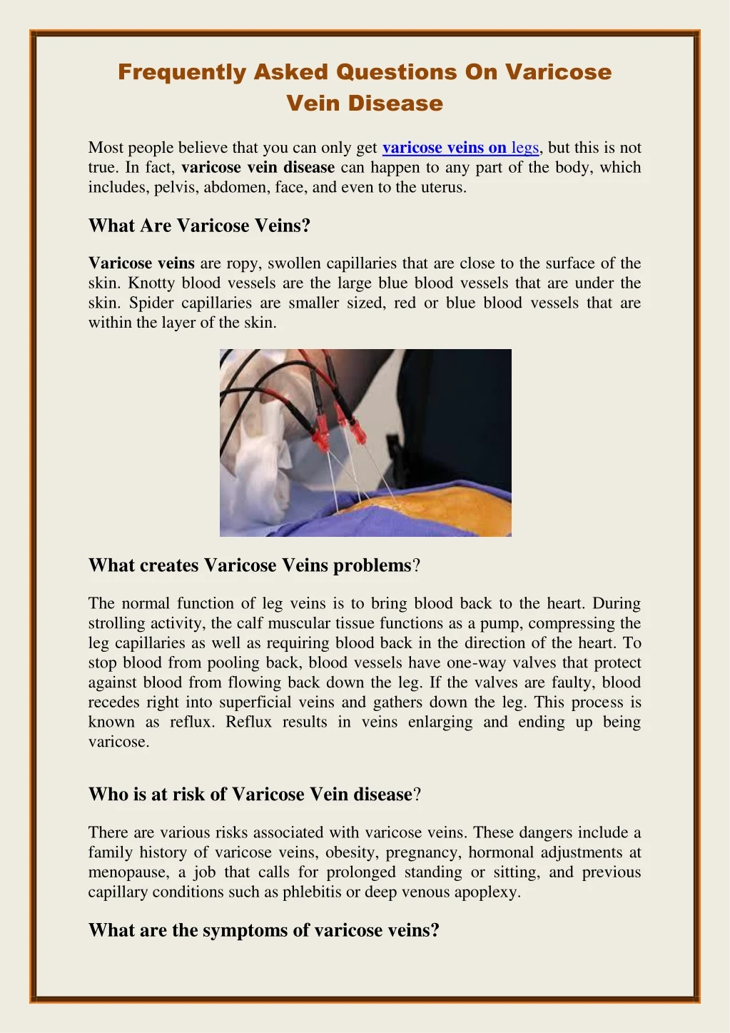 frequently asked questions on varicose vein