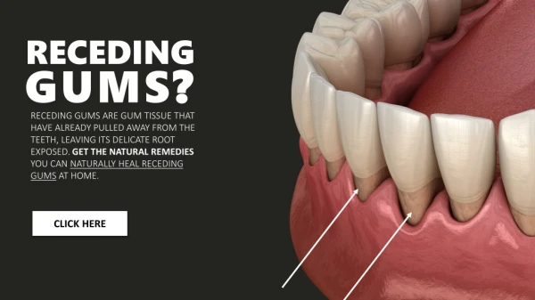 What Helps Receding Gums Naturally?