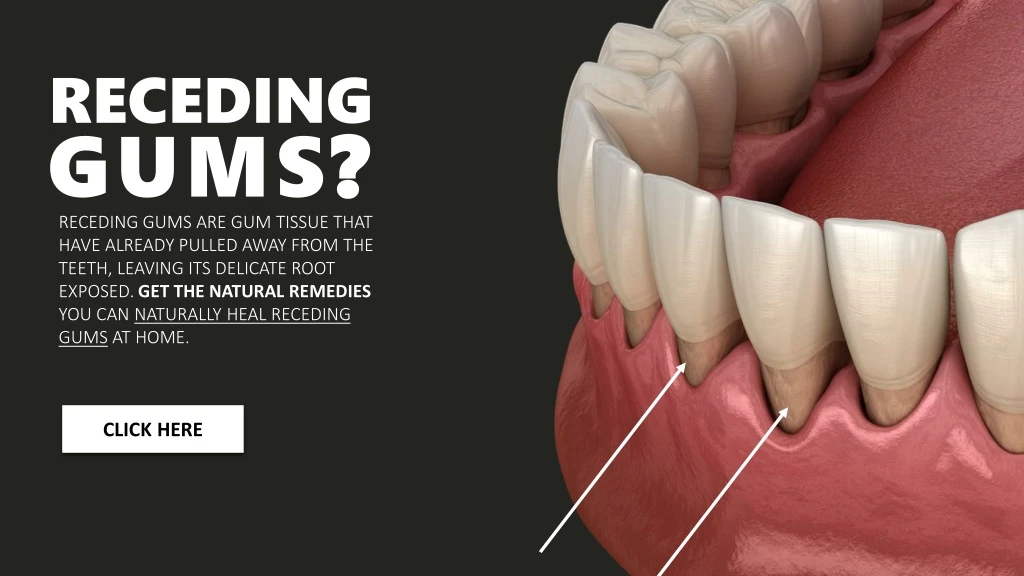 receding gums receding gums are gum tissue that