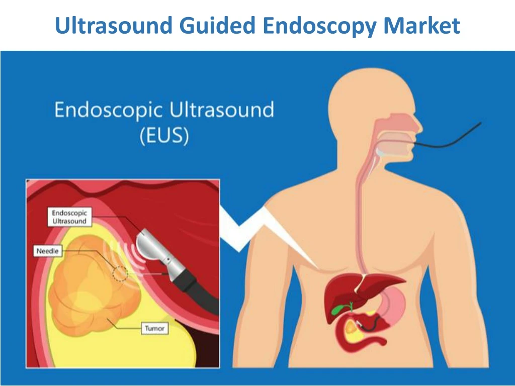 ultrasound guided endoscopy market