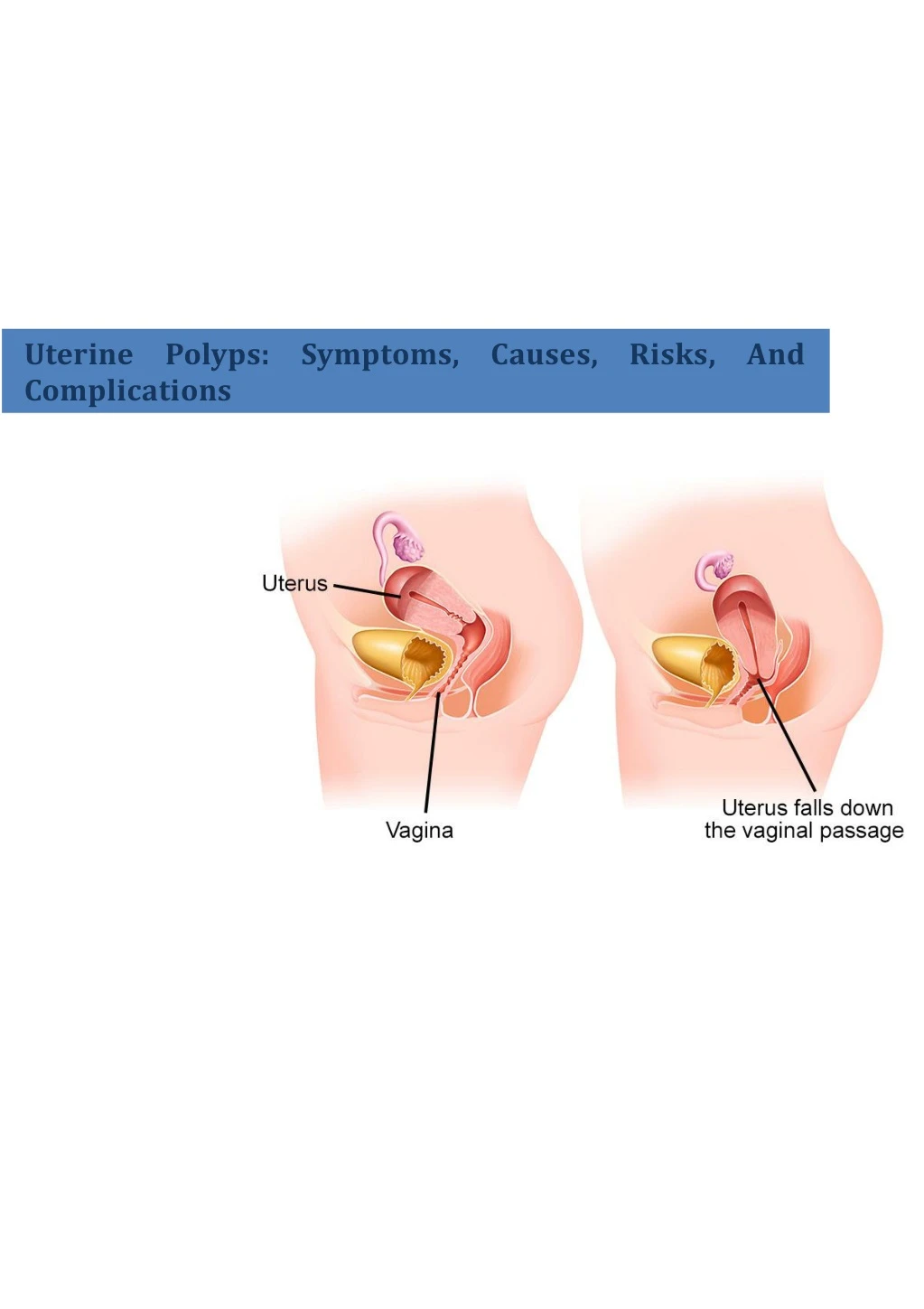 uterine polyps symptoms causes risks