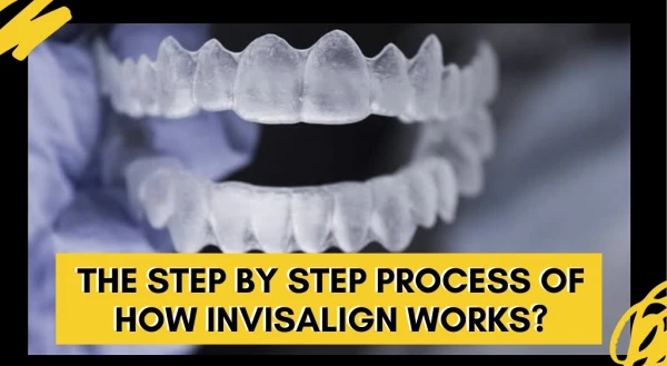 Invisalign Braces For All Stages Of Life