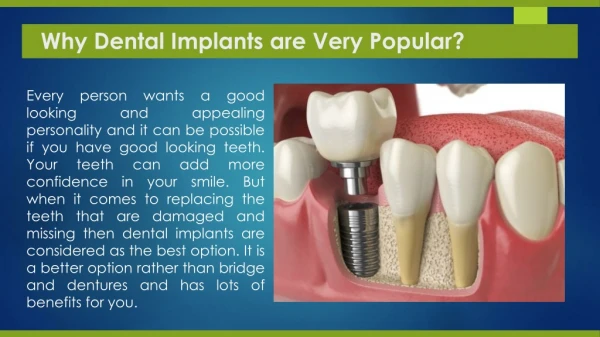 Why Dental Implants are Very Popular?