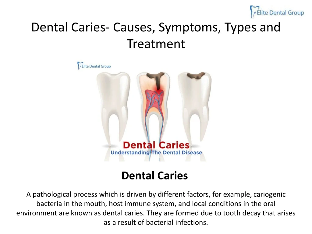 dental caries causes symptoms types and treatment