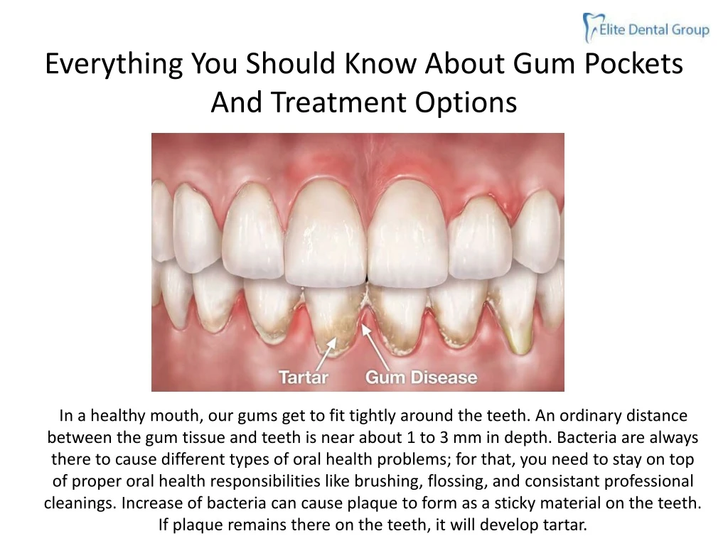 everything you should know about gum pockets and treatment options