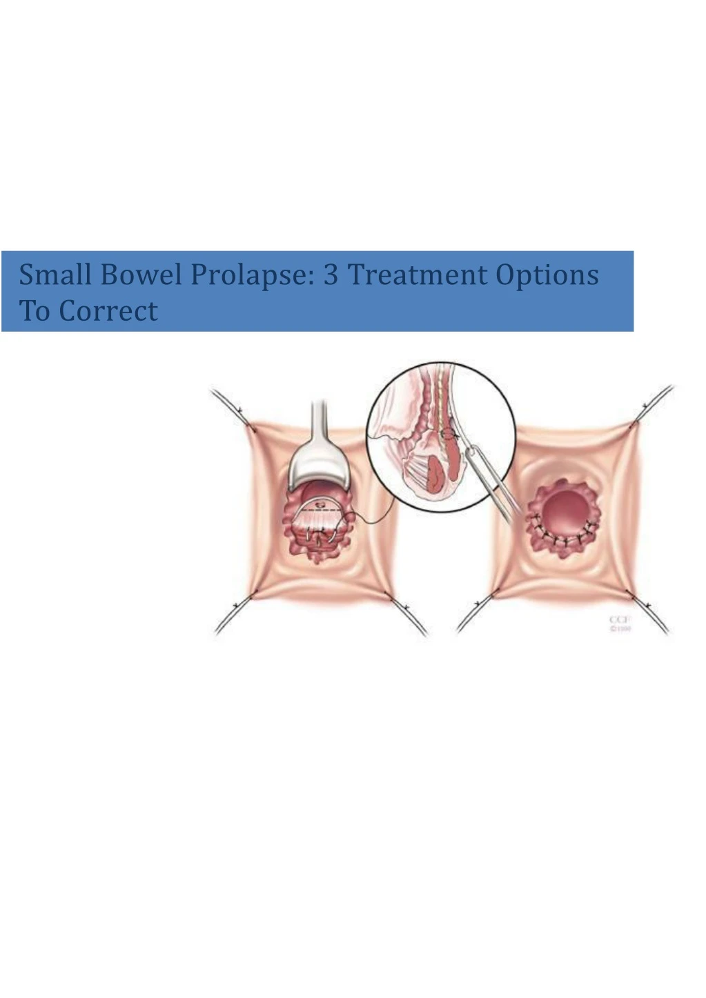 small bowel prolapse 3 treatment options