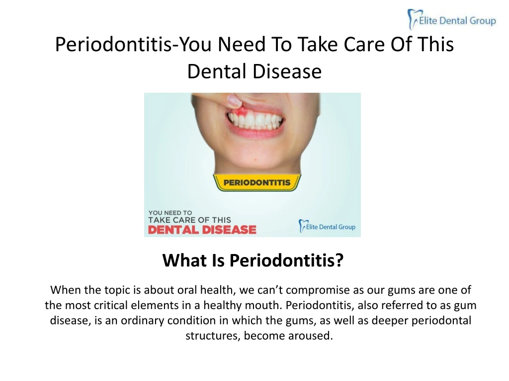 periodontitis you need to take care of this dental disease