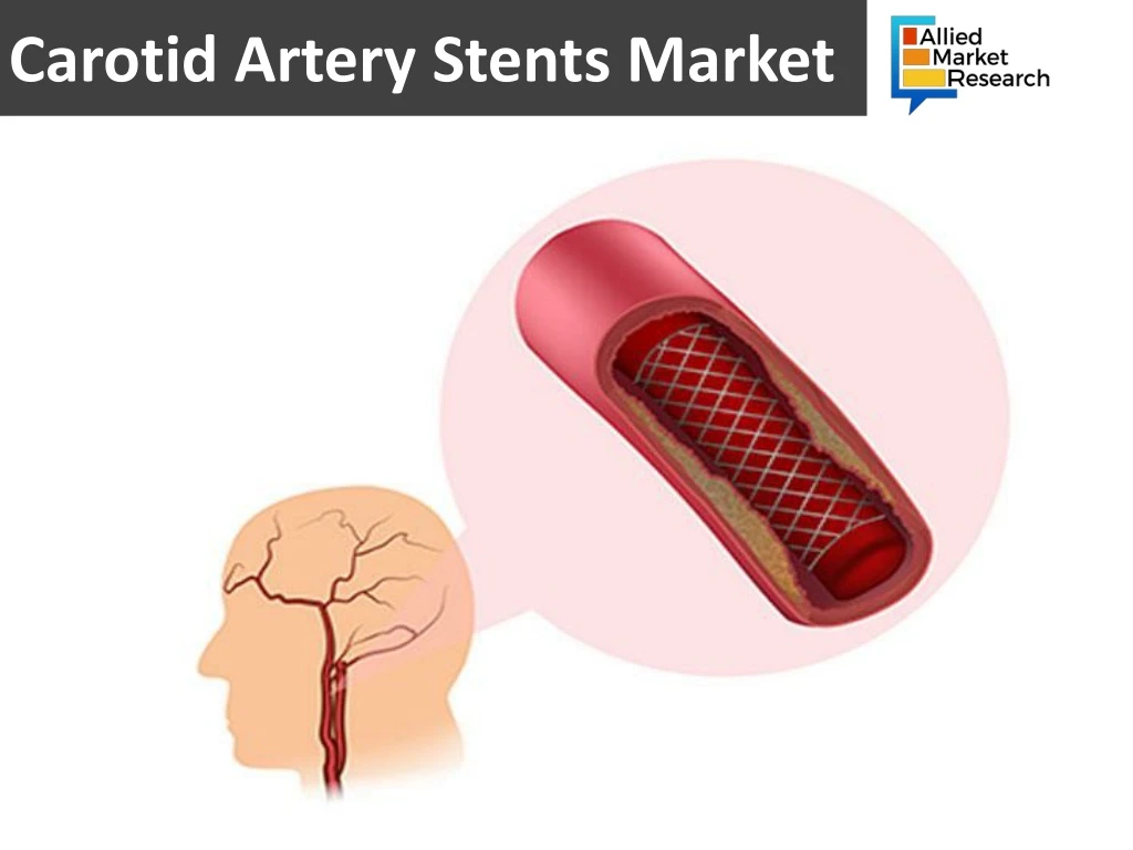 carotid artery stents market