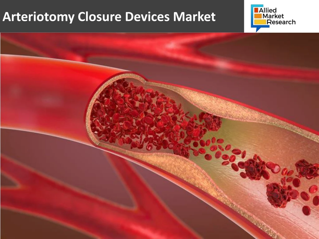 arteriotomy closure devices market