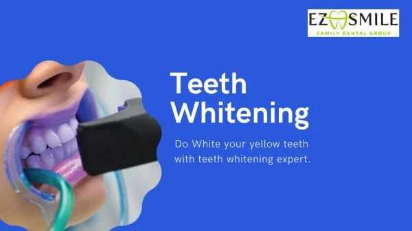 Why Teeth Whitening is popular?