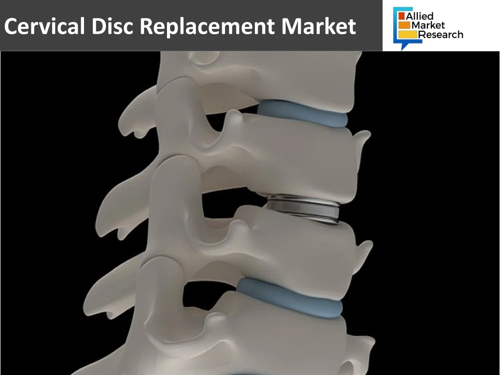 cervical disc replacement market