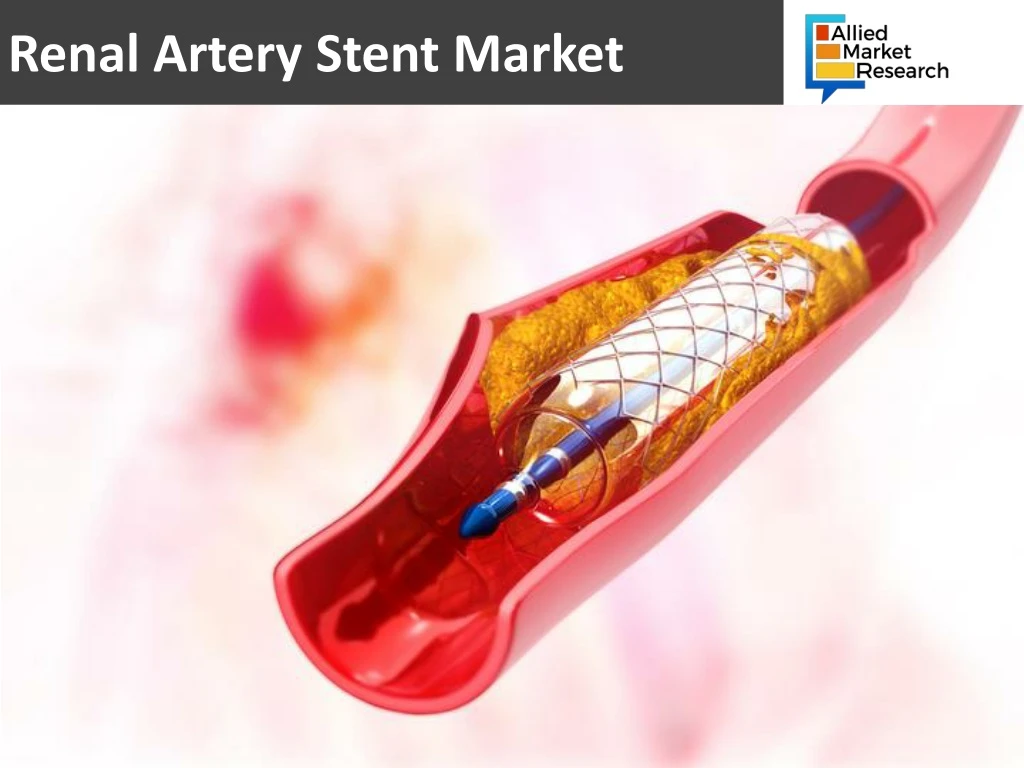 renal artery stent market