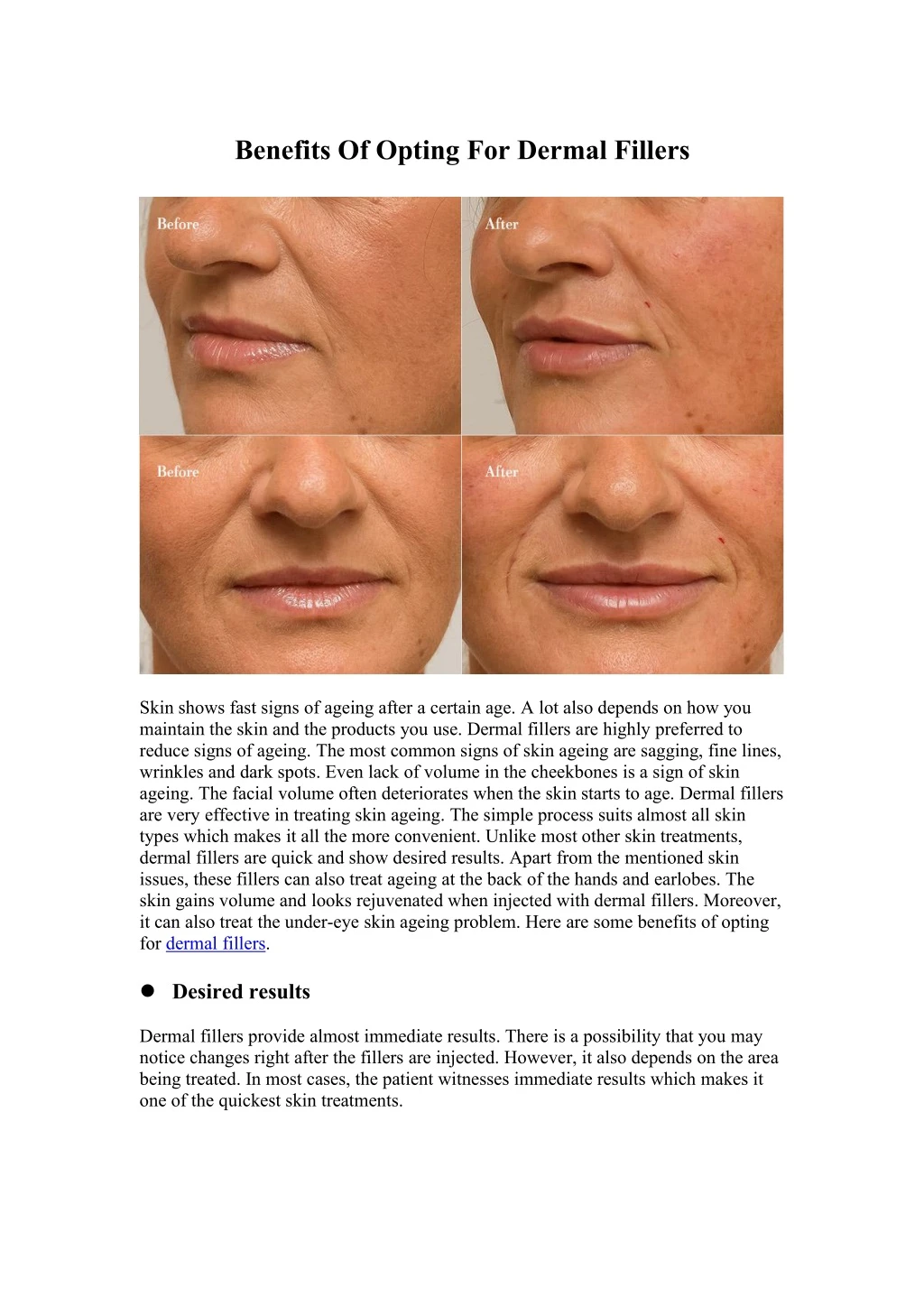 benefits of opting for dermal fillers