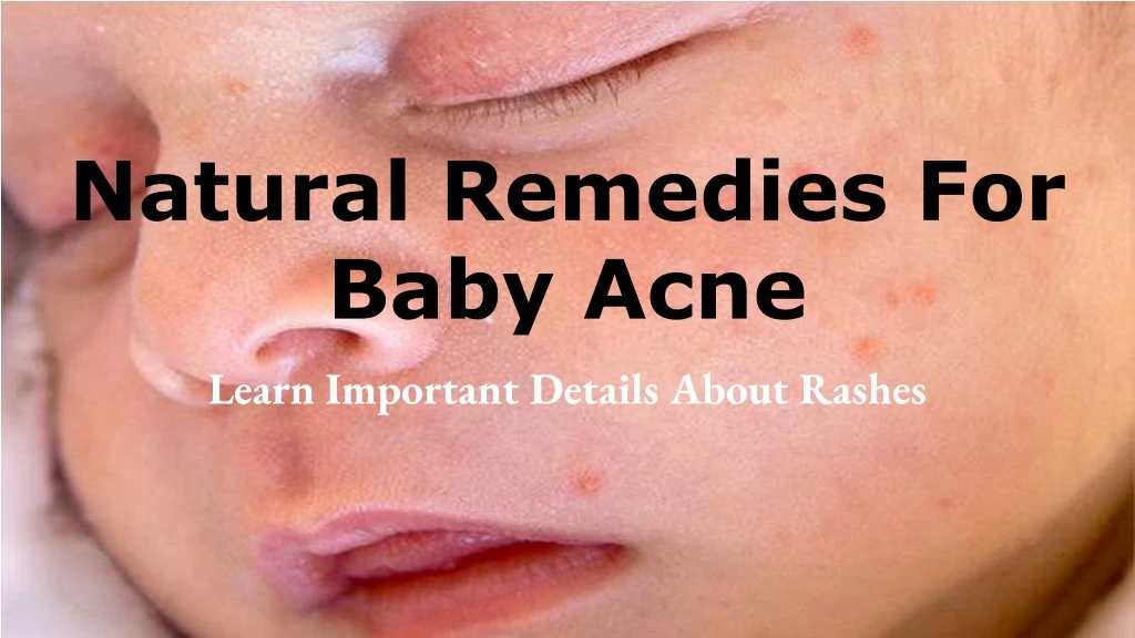 natural remedies for baby acne