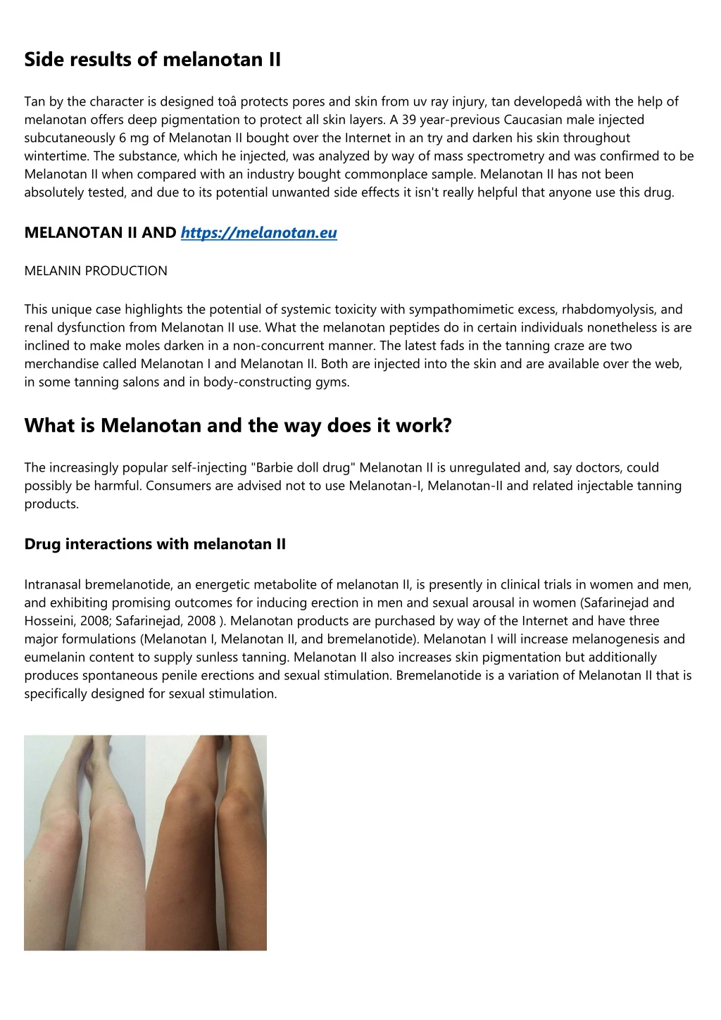 side results of melanotan ii