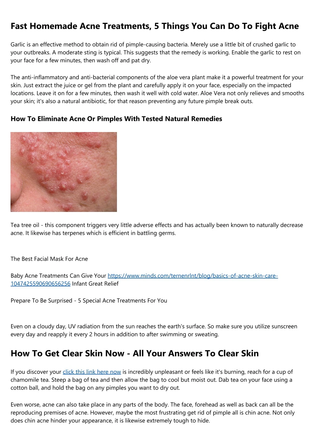 fast homemade acne treatments 5 things