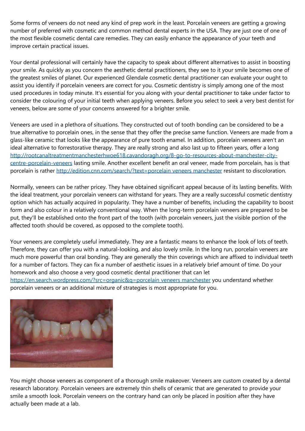 some forms of veneers do not need any kind