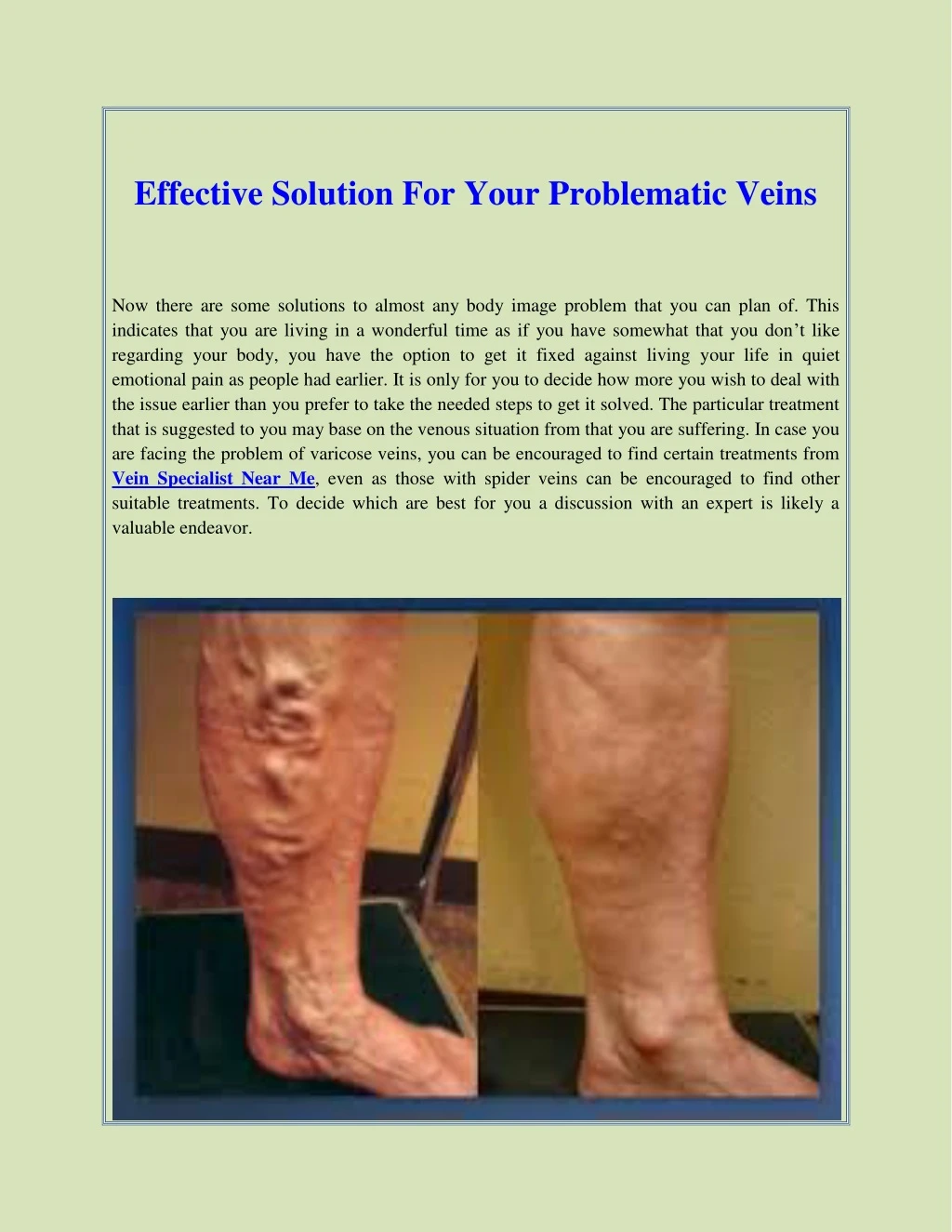 effective solution for your problematic veins
