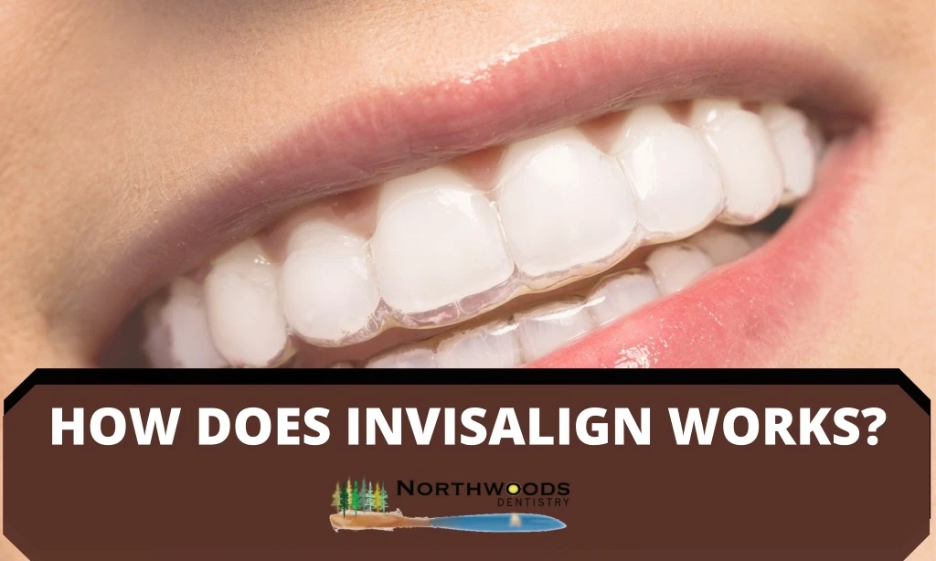 how does invisalign works