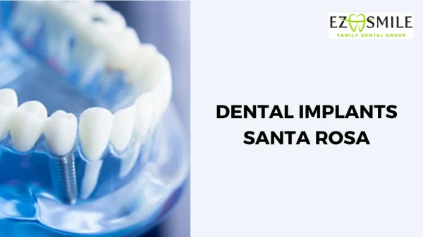 Dental Implants Santa Rosa – Expert Dentist