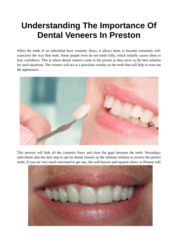 Understanding The Importance Of Dental Veneers In Preston